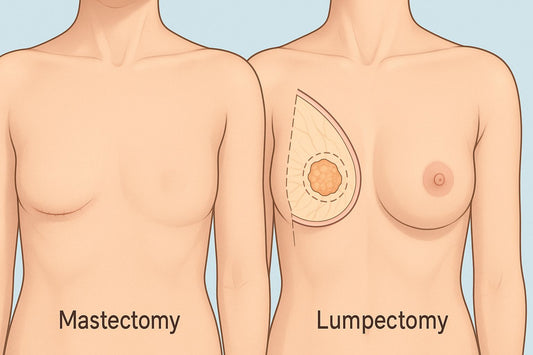 Mastectomy vs. Lumpectomy: Understanding Your Surgical Options